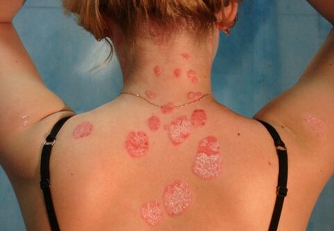 psoriasis of the back