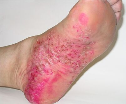 psoriasis of the foot